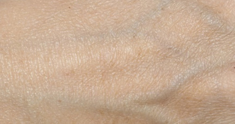 症例6　老人性色素斑（右手の甲のしみ）レーザー治療 治療後