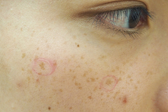 症例7　雀卵斑（頬のそばかす）レーザー治療 治療前