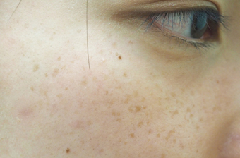 症例7　雀卵斑（頬のそばかす）レーザー治療 治療後