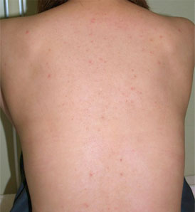 症例7　ケミカルピーリング（背中ニキビ） 治療前