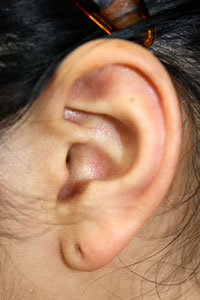 症例10　ピアス穴あけ（左耳介軟骨アウターコンク・ピアス、右耳介軟骨トラガス・ピアス） 施術前