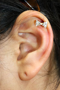 症例10　ピアス穴あけ（左耳介軟骨アウターコンク・ピアス、右耳介軟骨トラガス・ピアス）施術後