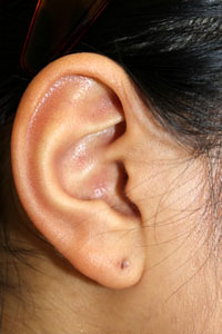 症例10　ピアス穴あけ（左耳介軟骨アウターコンク・ピアス、右耳介軟骨トラガス・ピアス ）施術前