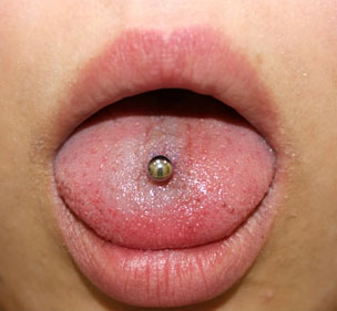 症例13　ピアス穴あけ（舌ピアス） 施術後