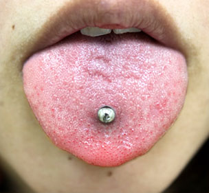 症例14　ピアス穴あけ（舌ピアス） 施術後