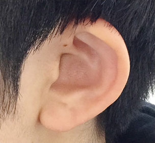 症例1　ピアス穴あけ（耳たぶ）2か所 施術前