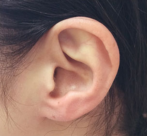 症例2　ピアス穴あけ（耳たぶ）２か所 施術前