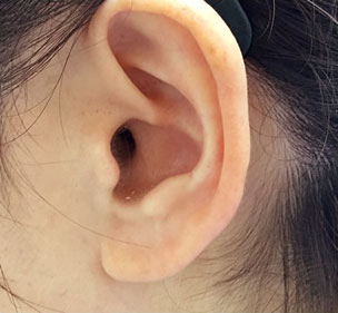 症例3　ピアス穴あけ（耳たぶ） 施術前