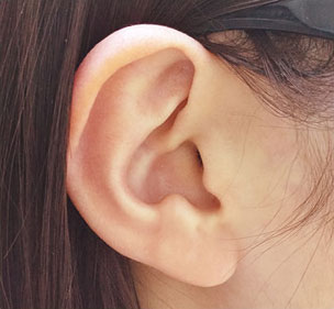 症例4　ピアス穴あけ（耳たぶ） 施術前