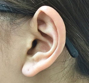 症例6　ピアス穴あけ（耳介軟骨アウターコンク・ピアス） 施術前