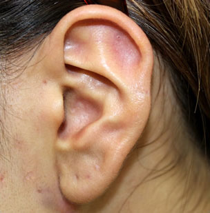 症例9　ピアス穴あけ（耳介軟骨インナーコンク・ピアス） 施術前