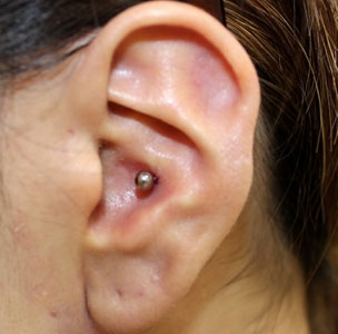 症例9　ピアス穴あけ（耳介軟骨インナーコンク・ピアス） 施術後