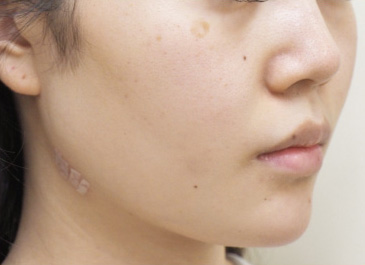 症例3　下顎形成術・エラ削り 手術後
