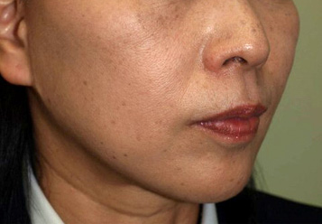 症例1　フェイスリフト+スレッドリフト（頬～あご） 手術後