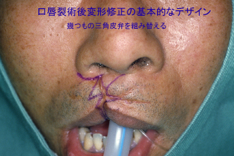 症例1　口唇裂口蓋裂術後修正手術 手術デザイン