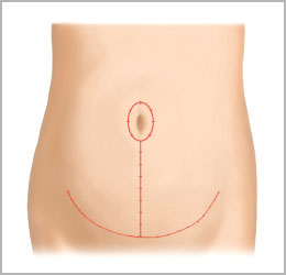 脂肪吸引＋腹壁形成術（タミータック手術）2