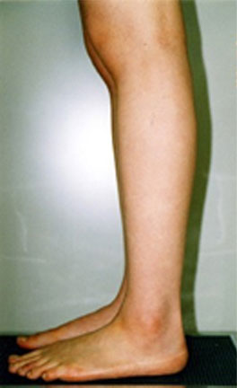 症例4　ふくらはぎ・足首の脂肪吸引 手術後