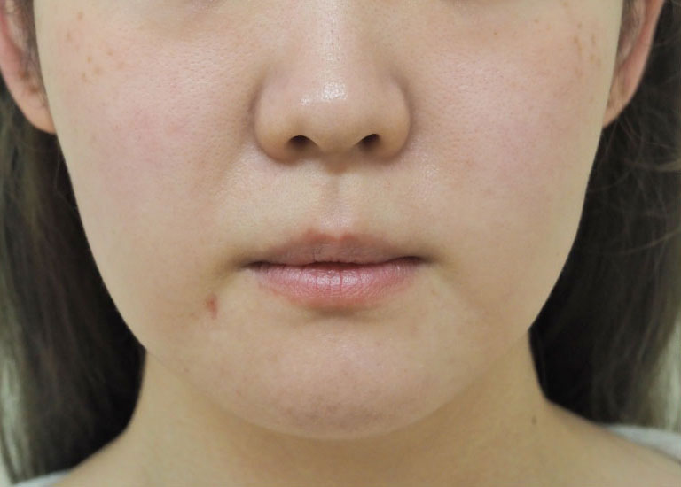 症例3　頬の脂肪吸引 手術後