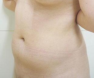 症例5　腹部の脂肪吸引 手術前