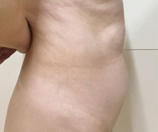 症例7　腹部・腰部の脂肪吸引 手術前