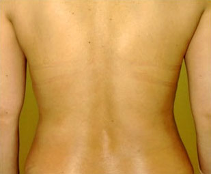症例8　背部の脂肪吸引 手術前