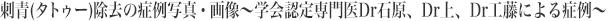 刺青(タトゥー)除去の症例写真・画像 〜学会認定専門医Dr石原、Dr上、Dr工藤による症例〜