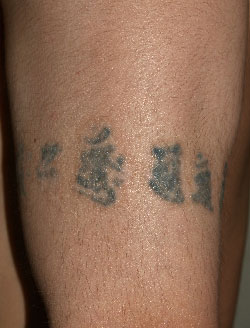 症例19　刺青（タトゥー）除去（切縫法） 手術前