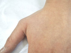 症例1　刺青（タトゥー）除去（レーザー） 治療後(左親指つけね)