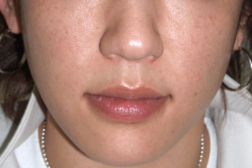 症例1　頬サーマクール 治療後