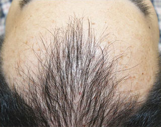症例2　頭髪治療（薄毛、抜け毛治療） 治療前