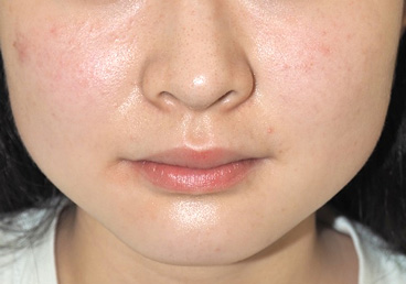 症例1　えら（小顔）ボトックス 施術前