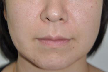 症例2　えら（小顔）ボトックスと脂肪溶解注射 治療後