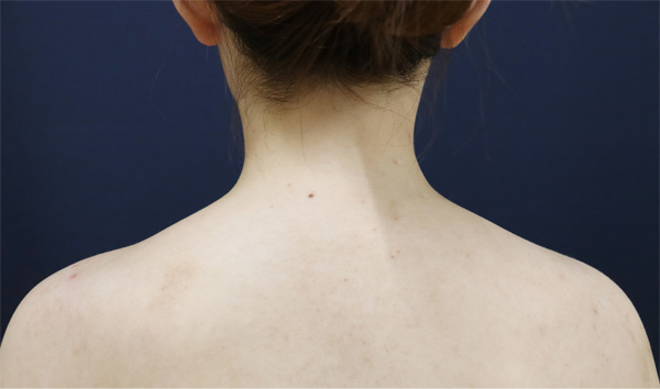 症例1　肩やせボトックス 手術後