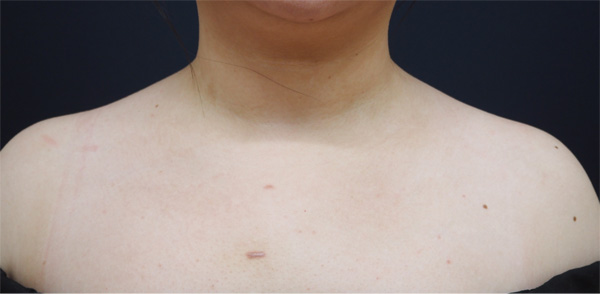 症例2　肩やせボトックス 手術前