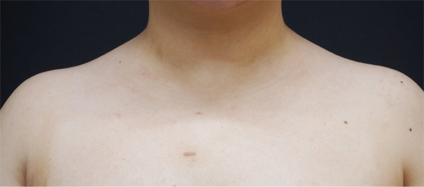 症例2　肩やせボトックス 手術後