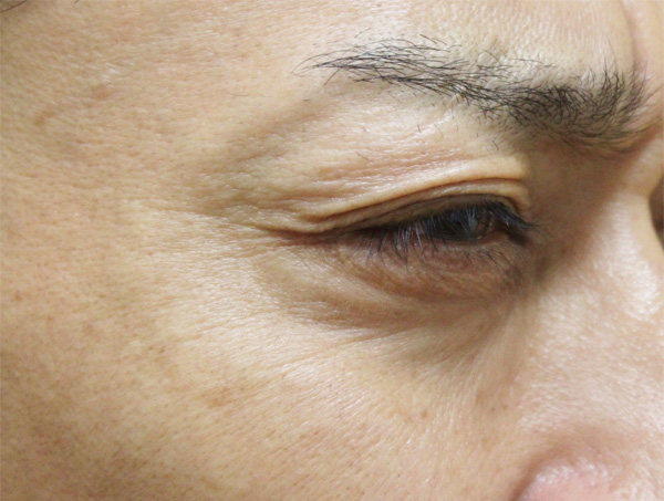 症例7　しわボトックス（目尻） 施術後