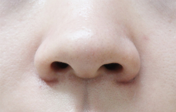 症例2　小鼻縮小ボトックス 施術後