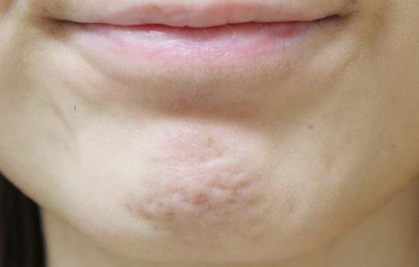 症例5　あごのしわボトックス 施術前