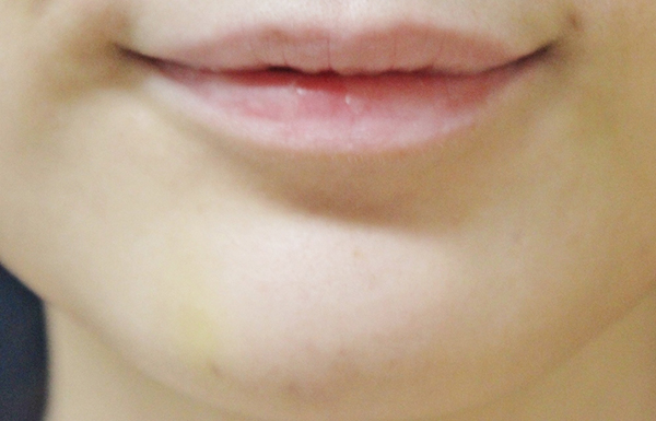 症例5　あごのしわボトックス 施術後