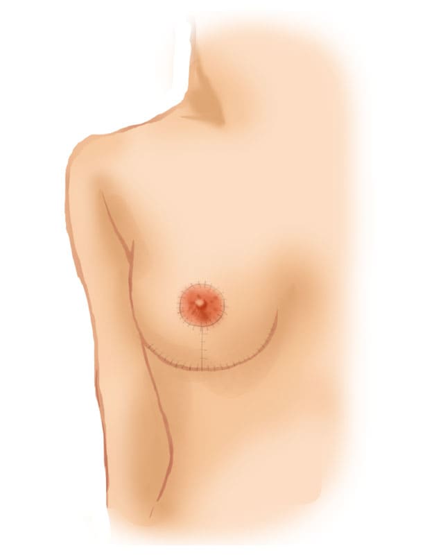乳房縮小術（リダクション）2