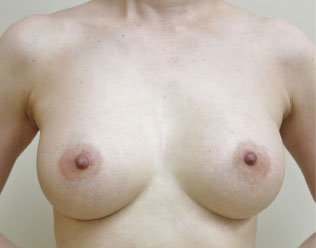 症例10　豊胸術（205ml） 手術後