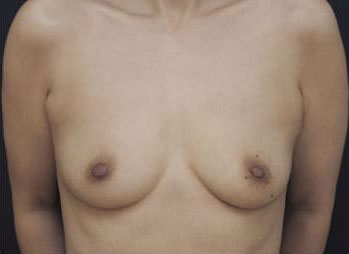 症例12　豊胸術（260ml） 手術前