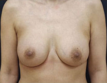 症例12　豊胸術（260ml） 手術後