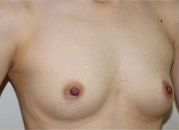 症例13　豊胸術（260ml） 手術前