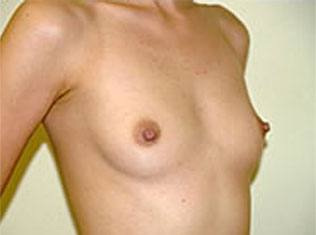 症例14　豊胸術（260ml） 手術前