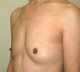 症例16　豊胸術（160ml） 手術前