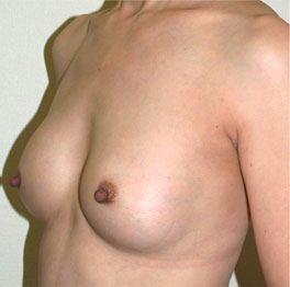 症例16　豊胸術（160ml） 手術後