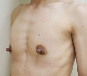 症例18　豊胸術（260ml） 手術前