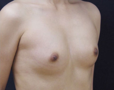症例20　豊胸術（205ml） 手術前