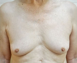 症例26　女性化を望む男性の豊胸術（200ml） 手術前